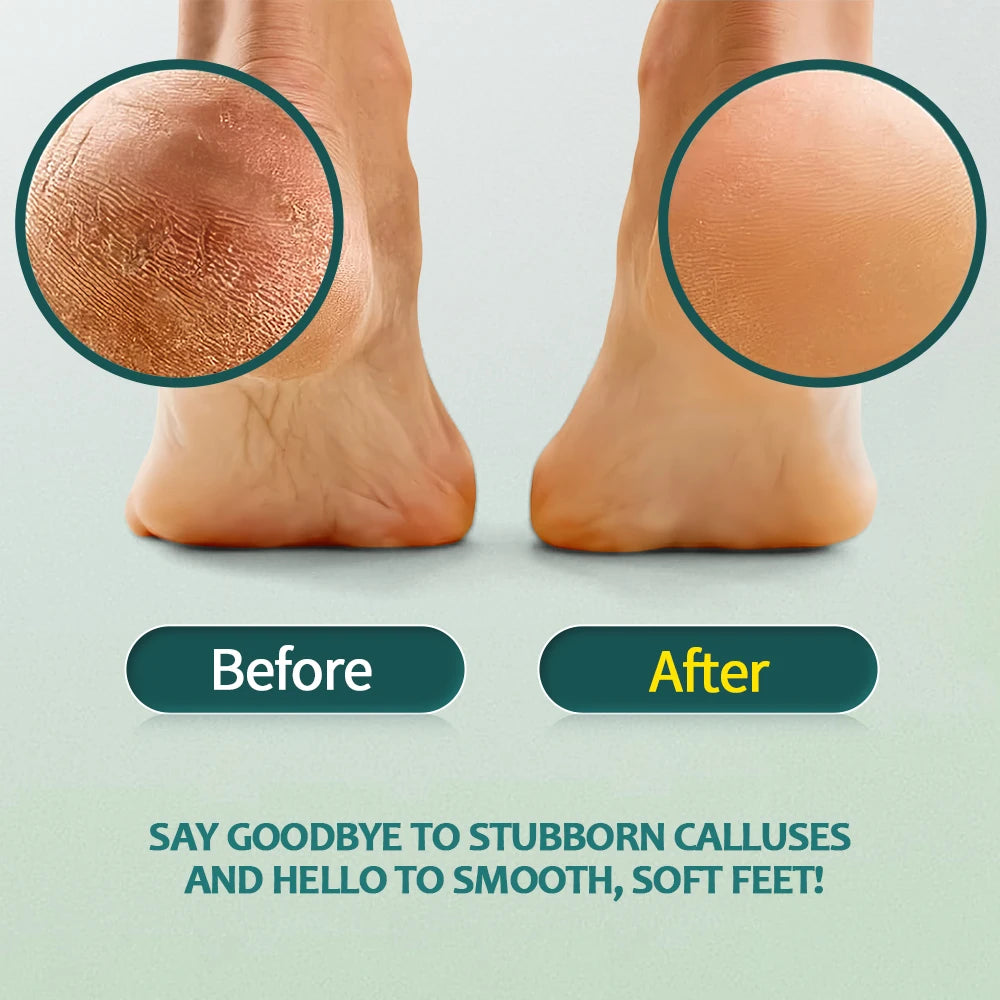 Kit Anti-Callosités Pieds — Râpe & Soin Talons